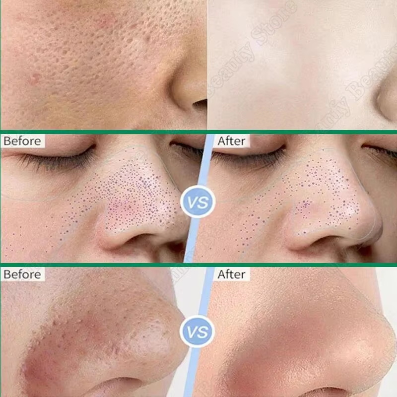 Salicylzuur Poriënreinigende C - Salicylic Acid Blackhead Remover recensie en prijs